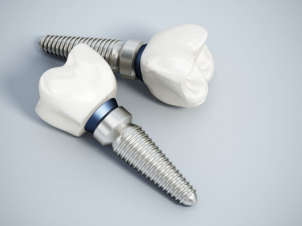 Affordable dental implants in Highland, MD