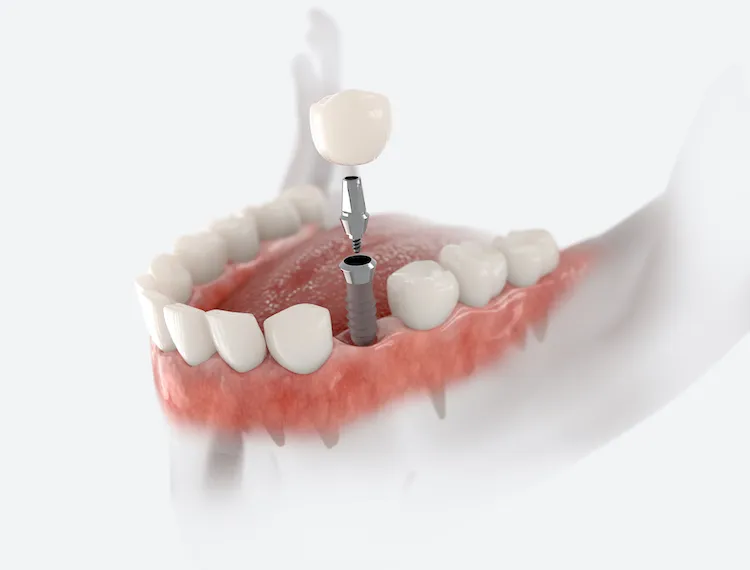 The Benefits of Dental Implants for Tooth Loss in Highland, MD