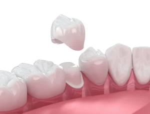 What Is a Dental Crown? A Simple Guide in Highland, MD